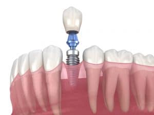 Service Dental Implant 300x225