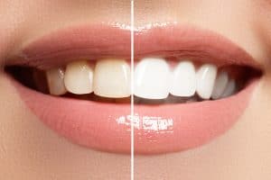 Service Whitening