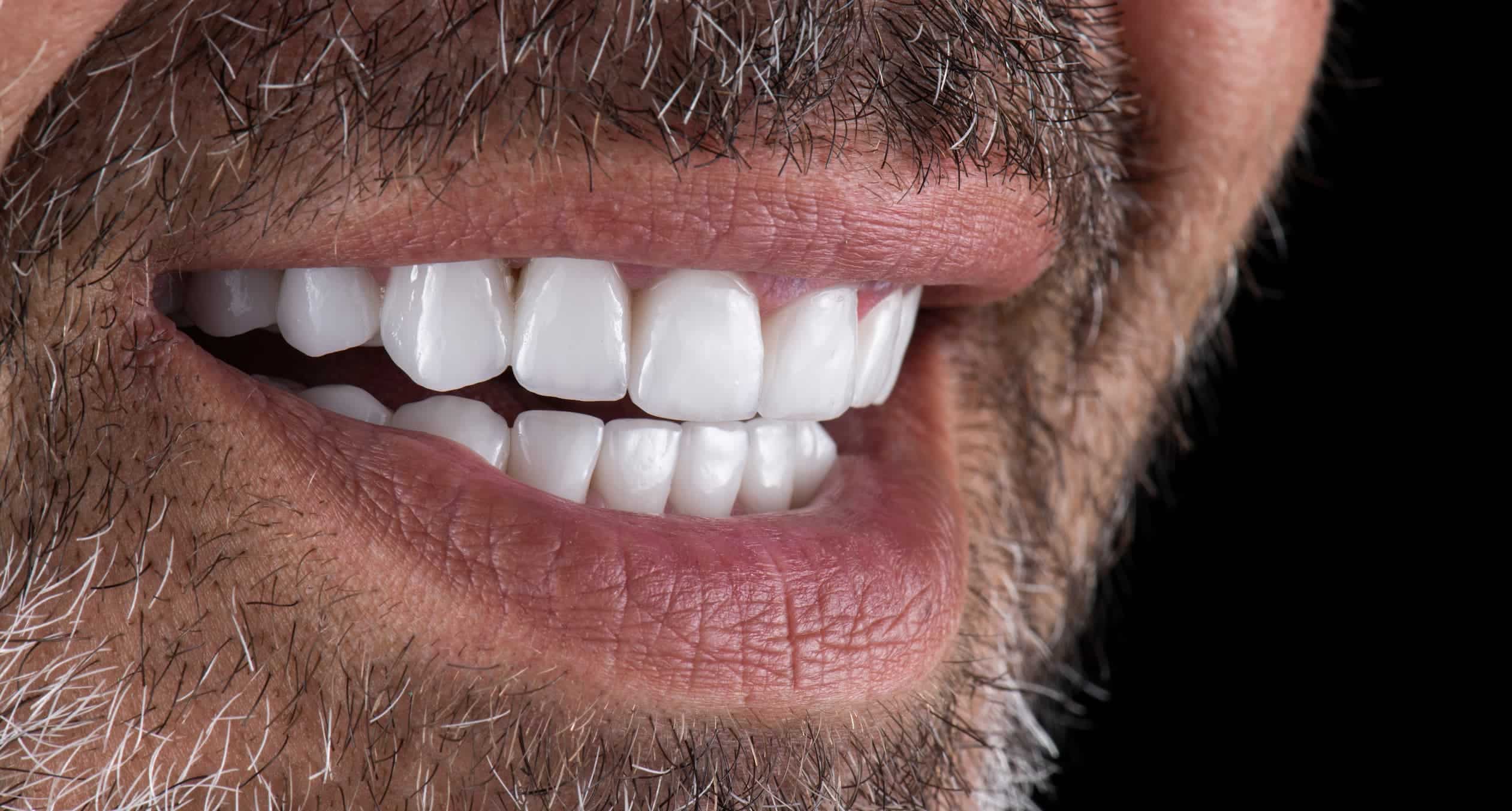 The benefits of dental veneers for improving your smile