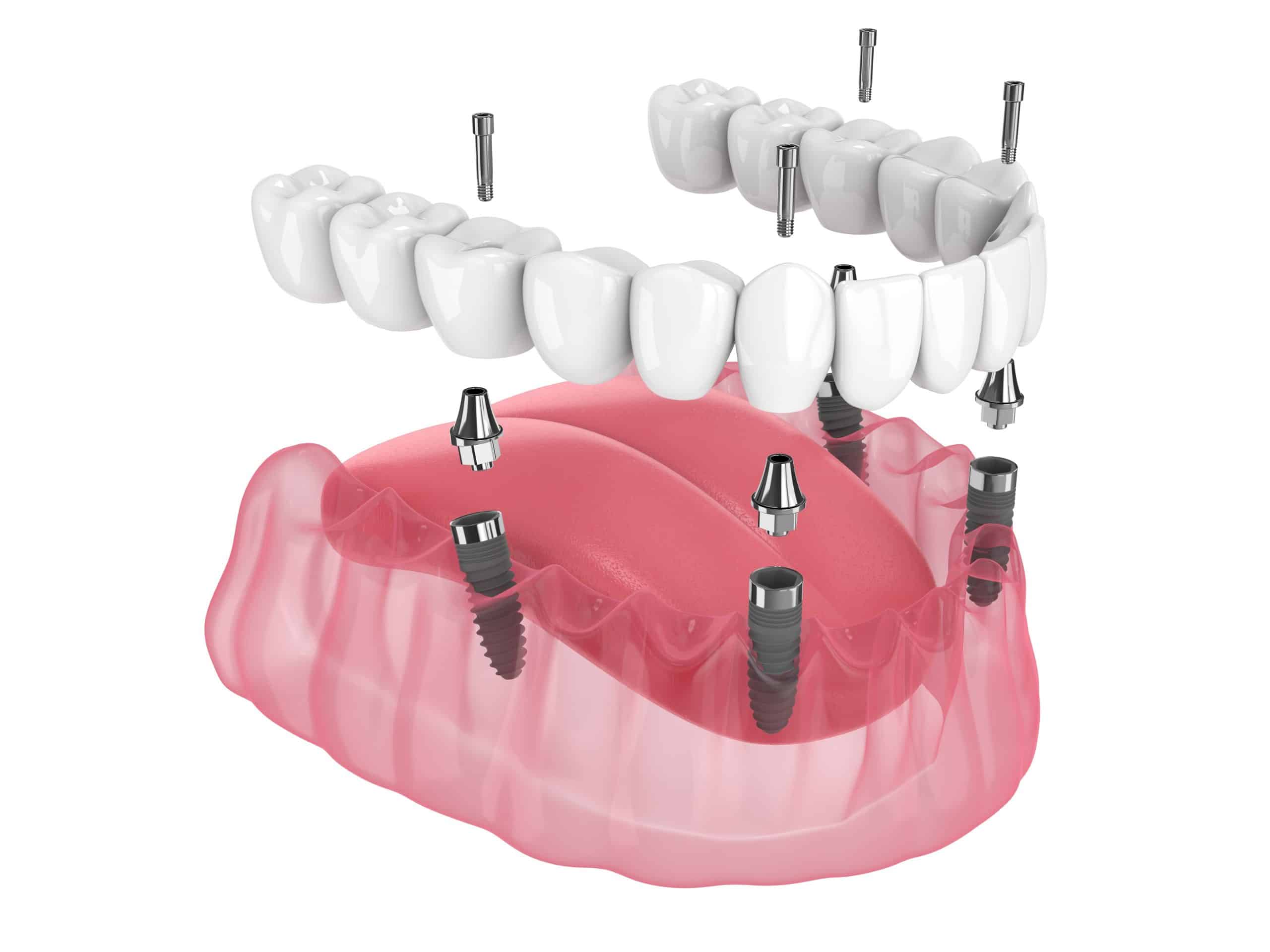 Maintaining Your New Smile: Tips for Caring for All-on-4 Implants at Flintridge Dental Studio