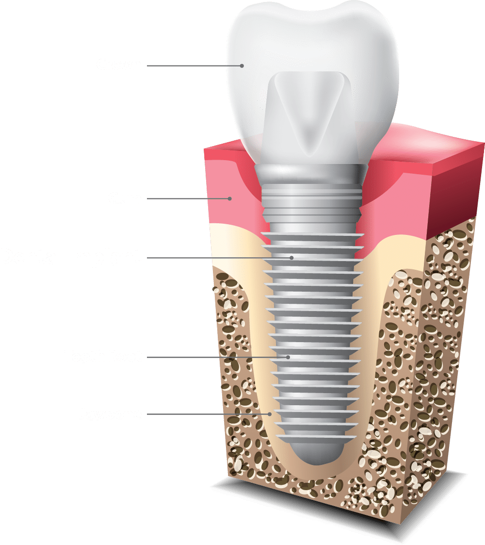 Anatomy Of An Implant